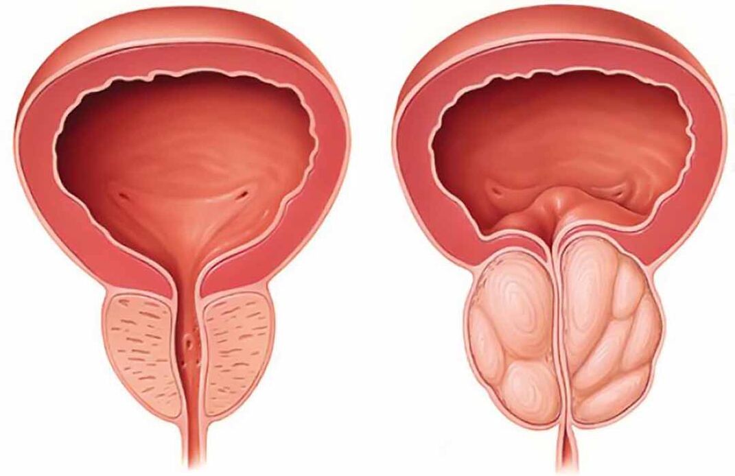 Próstata normal e inflamação da próstata (prostatite crônica)