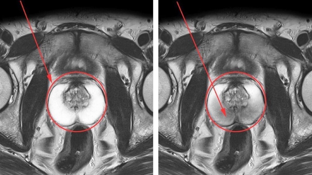 Ultrassom para prostatite crônica – próstata saudável (esquerda) e inflamada (direita)