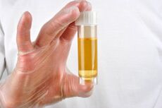O exame de urina é um dos métodos de diagnóstico de prostatite