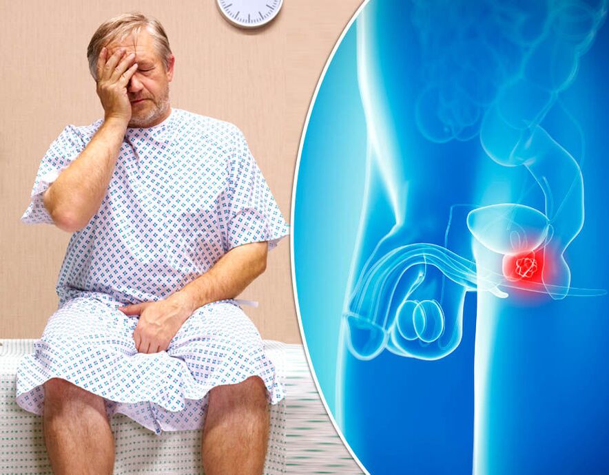 Homem com prostatite é diagnosticado com a doença