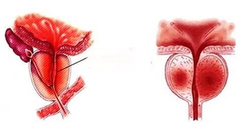 Como é a prostatite crônica